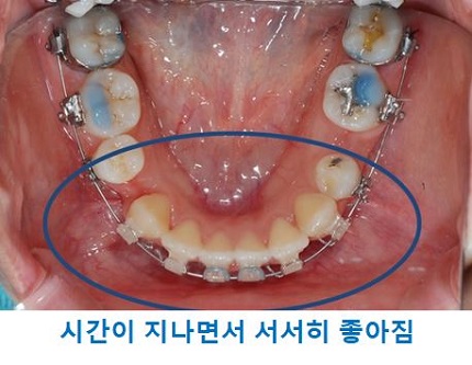 교정시작을 망설이게 하는 치아교정통증(1) 관련 이미지 13