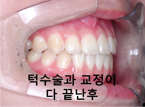 덧니와 주걱턱이 같이 있는 경우에 가장 효과적인 교정방법! 관련 이미지 20