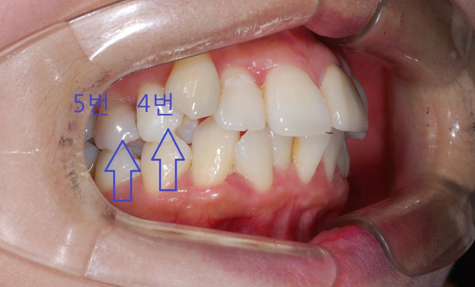 [치아교정후기]  덧니나 돌출입이 심할때는 제1소구치를 발치하게 됩니다. 만약 제2소구치가 씌운 상태라면... 관련 이미지 1