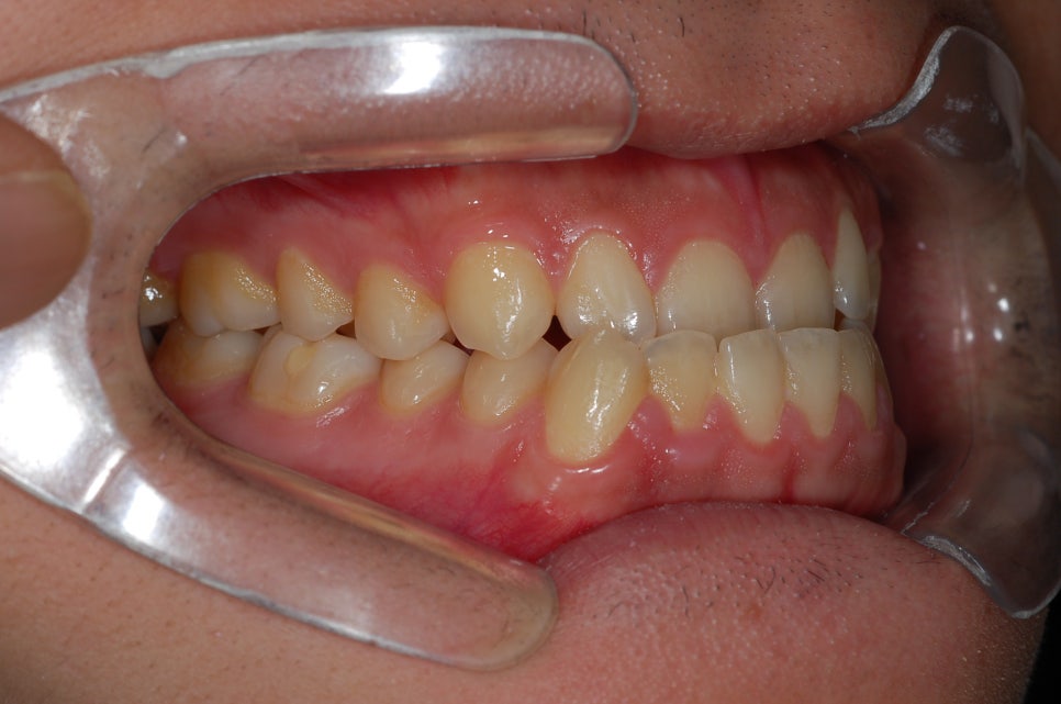 Can Braces Make the Lower Jaw Recede? When It’s Possible vs. When Surgery Is Needed image 5