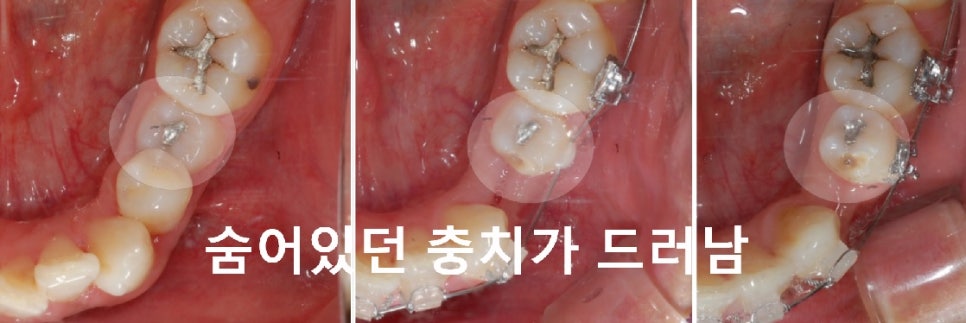 교정시작하려는데 충치치료를 먼저 해야하나요? 관련 이미지 4