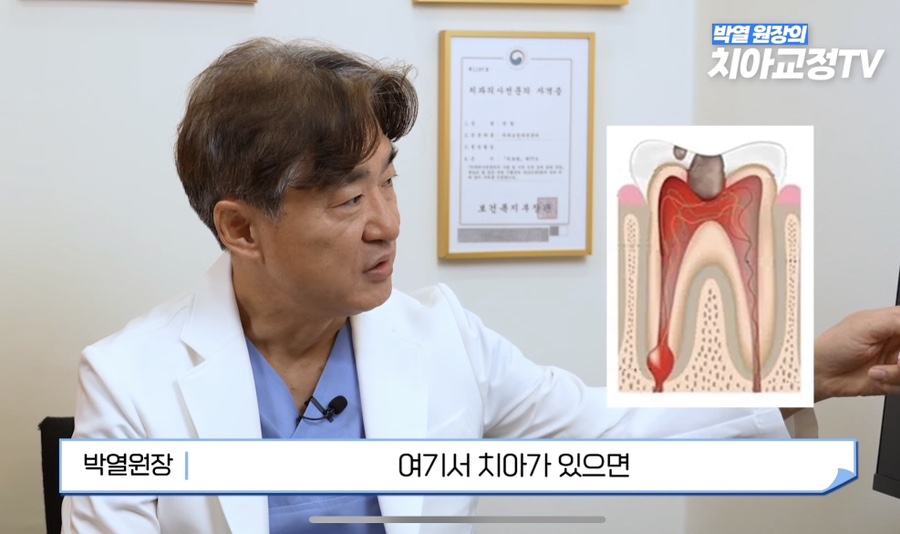 강남역치아교정, 신경치료 받은 치아도 교정이 될까? 관련 이미지 6