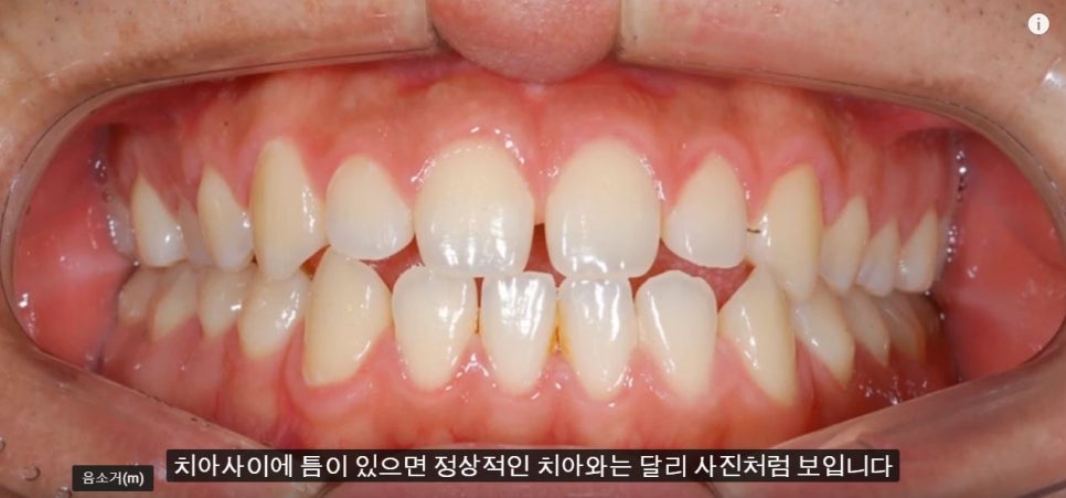 [치아교정] 치아사이에 틈새가 있는 부정교합(레진이나 라미네이트말고 치아교정으로 틈새닫기) 관련 이미지 1