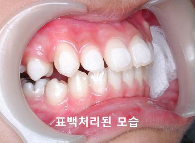 [교정기부착] 돌출입교정할때 교정기부착하는 법! 관련 이미지 5
