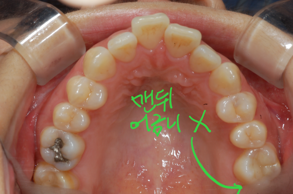[치아교정] 맨뒤어금니없는 경우의 돌출입교정전후. 교정끝나고 어금니임플란트해야. 차후 교정예정이신 분은 임플란트 먼저하는 것을 신중히 결정할것! 관련 이미지 1