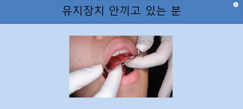 [치아교정] 치아교정 끝나고 요새 유지장치 안끼시는 분들 꼭 보시고 새출발하세요~~!! (돌출입교정, 덧니교정, 양악수술교정, 앞니교정한 분들 모두 해당됩니다) 관련 이미지 2