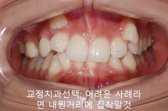 교정치과 잘 고르는 법! 먼 치과, 근처치과!! 관련 이미지 2