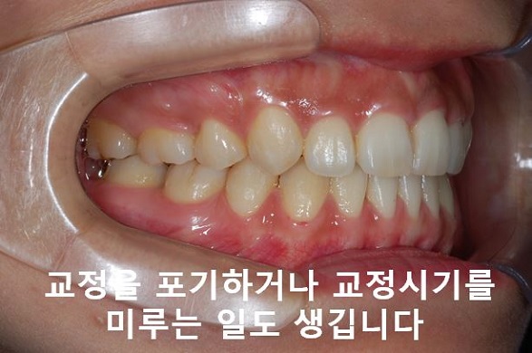 대학생 돌출입교정 망하지 않는 법! 관련 이미지 8