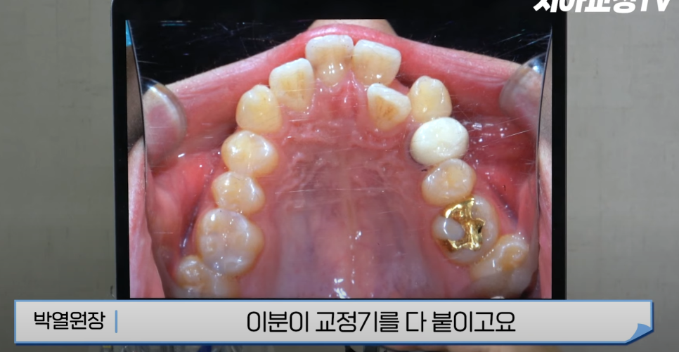 강남역 교정치과 :: 앞니 교정 시작 전에 꼭 알아야 할 한 가지 사실! 관련 이미지 6