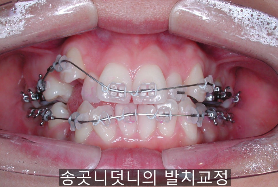 치아교정기간 짧아지는 방법 6가지! 관련 이미지 9