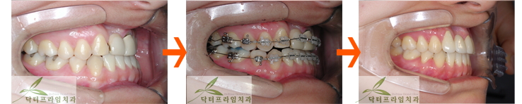 [치아교정후기] 앞니크라운 있는 경우의 치아교정전후 관련 이미지 2