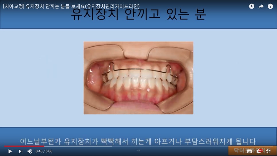 [치아교정] 유지장치 안끼고 있는 분들은 꼭 보세요!! 관련 이미지 1