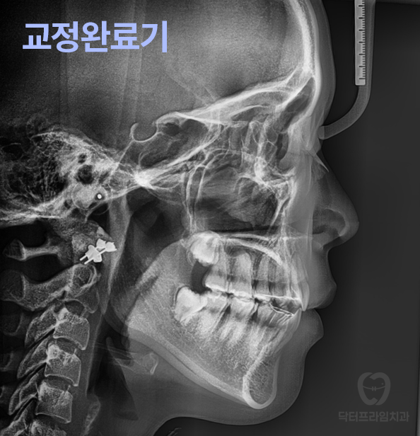 강남역 교정치과, 돌출입 발치교정하면 합죽해진다? 그렇습니다. 사실입니다 관련 이미지 14