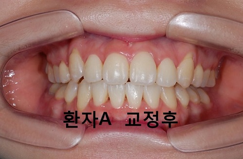 덧니와 주걱턱이 같이 있는 경우에 가장 효과적인 교정방법! 관련 이미지 11