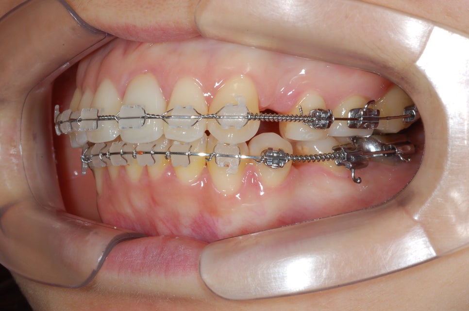 [치아교정] 20대성인여자 돌출입교정. 맨뒤어금니에 아말감치료상태->교정기 자주 탈락할수도 있어. 이럴 경우 어떻게 교정하지?? 관련 이미지 5