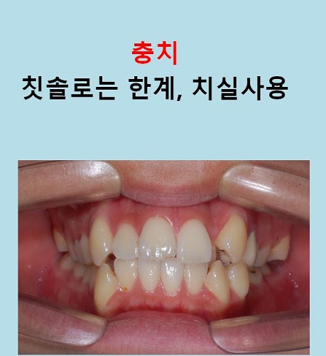 교정만으로 개선가능한 안면비대칭 알아보기(닥터프라임치과) 관련 이미지 4