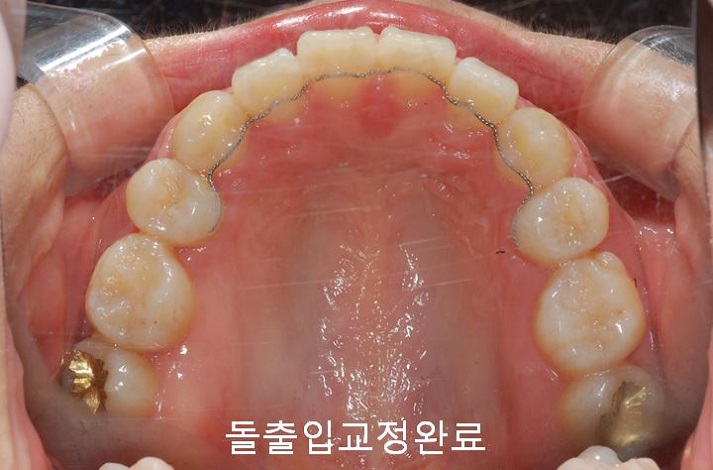 치아교정) 유지장치는 평생 해야 한다? 관련 이미지 4