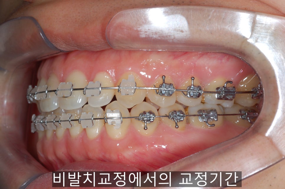 치아교정기간 짧아지는 방법 6가지! 관련 이미지 8