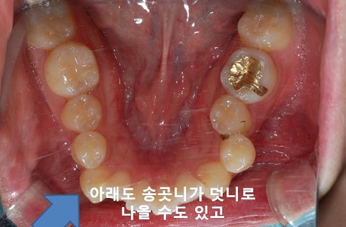 덧니교정과정, 4가지 요점만 알고 시작하세요! 관련 이미지 6
