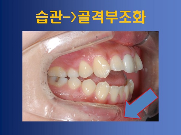 성장기 부정교합 방치했을때의 부작용! 관련 이미지 5