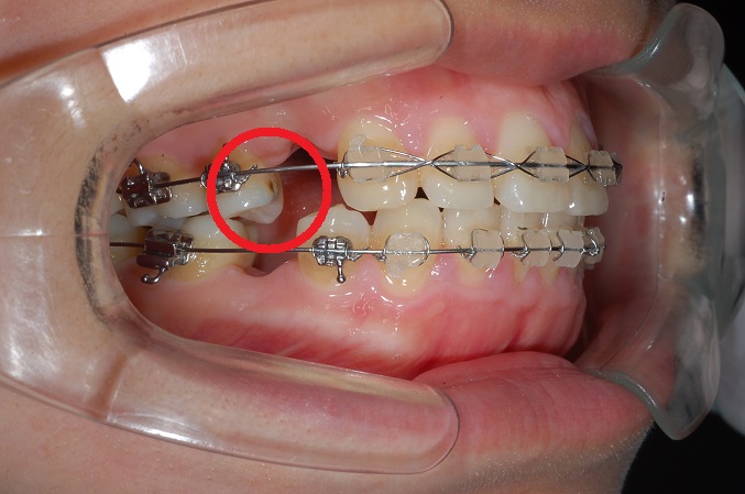 치아교정진행중이라도 충치치료하세요. 관련 이미지 2