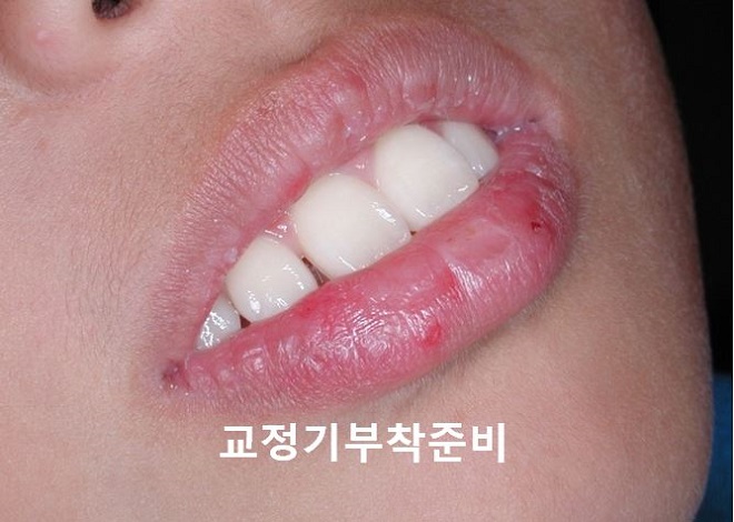 [교정기부착] 돌출입교정할때 교정기부착하는 법! 관련 이미지 2
