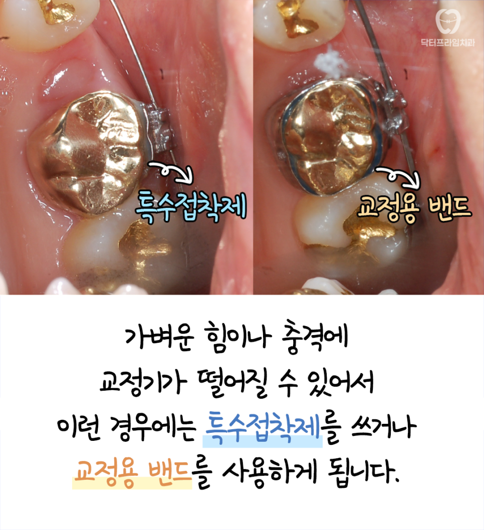 지르코니아, 골드크라운, 브릿지가 있어도 교정 가능한가요? &ndash; 주의할 점과 교정 후 관리까지 관련 이미지 2