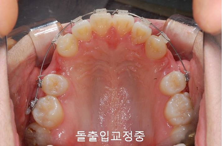 치아교정) 유지장치는 평생 해야 한다? 관련 이미지 3