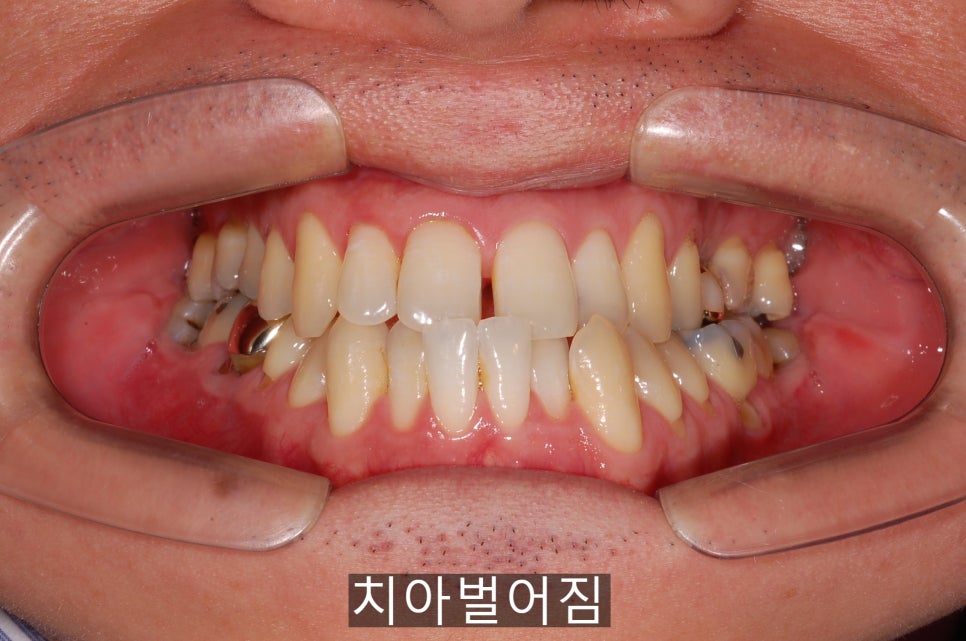 20세이상의 치아벌어짐, 교정 Vs 라미네이트! 관련 이미지 1