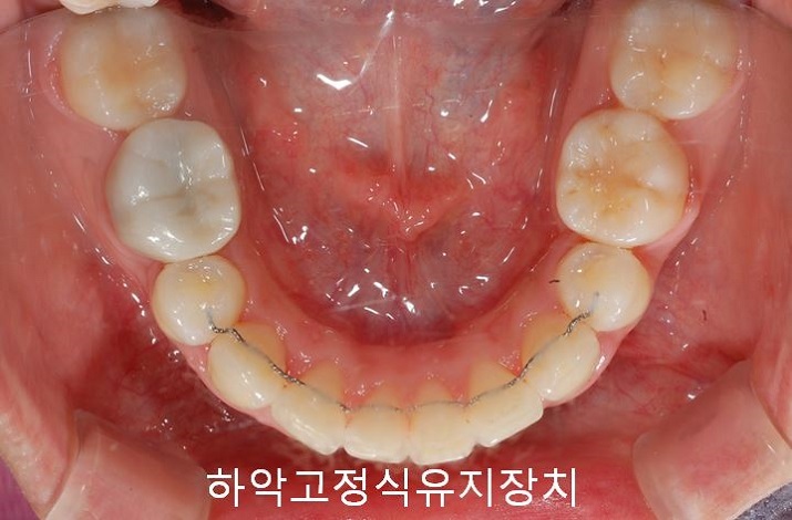 치아교정) 유지장치는 평생 해야 한다? 관련 이미지 9