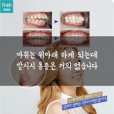 돌출입 교정 중 발치교정 과정 알아보기! 관련 이미지 3