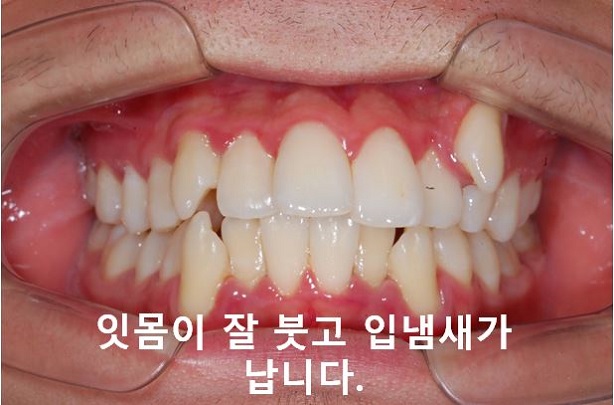 청소년, 덧니교정 안하면 이렇게 된다! 관련 이미지 3