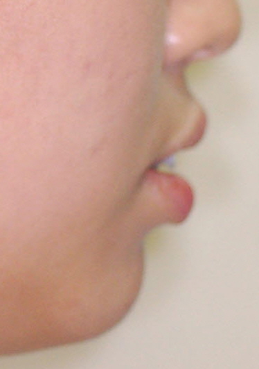 치아교정얼굴변화 관련 이미지 10