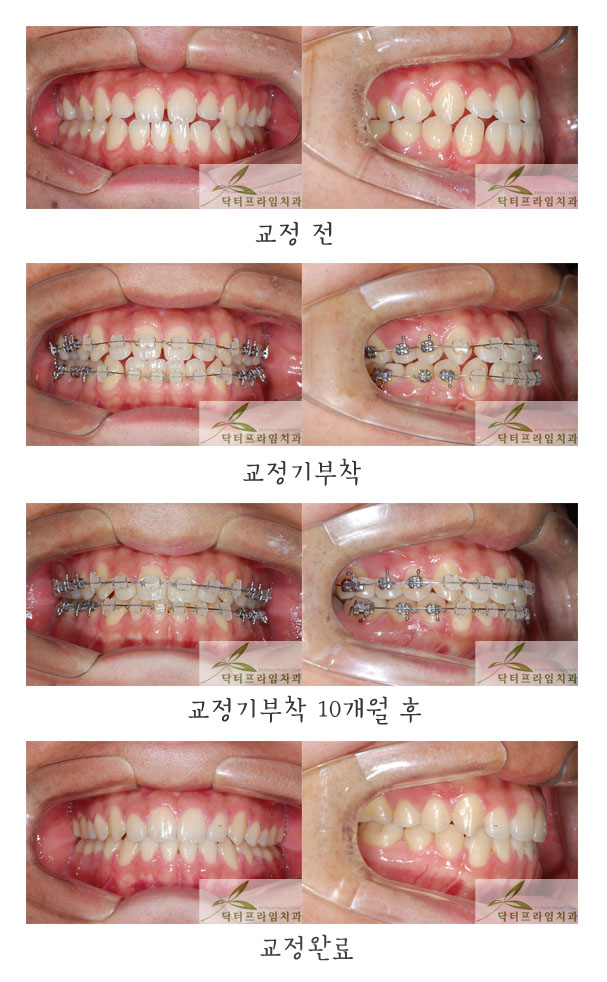 [치아교정후기] 벌어진 앞니틈새, 벌어진 치아를 비발치단기교정으로 완료! 관련 이미지 1
