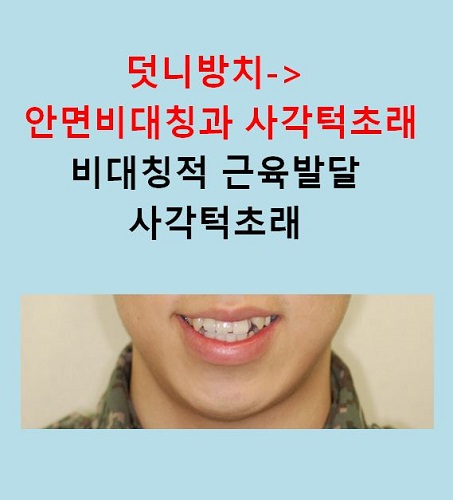 교정만으로 개선가능한 안면비대칭 알아보기(닥터프라임치과) 관련 이미지 11