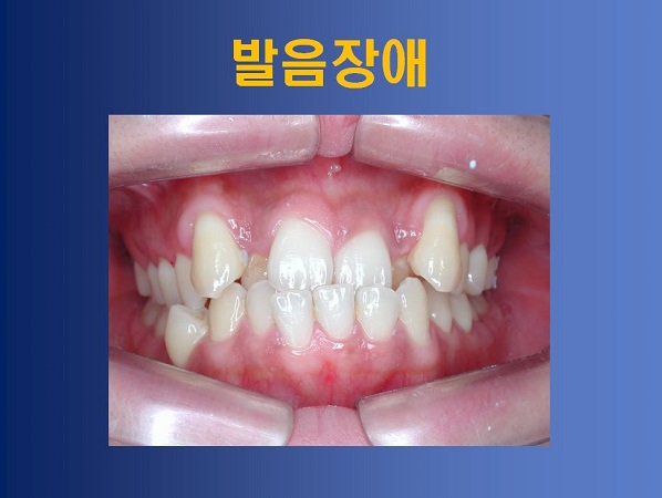 성장기 부정교합 방치했을때의 부작용! 관련 이미지 8
