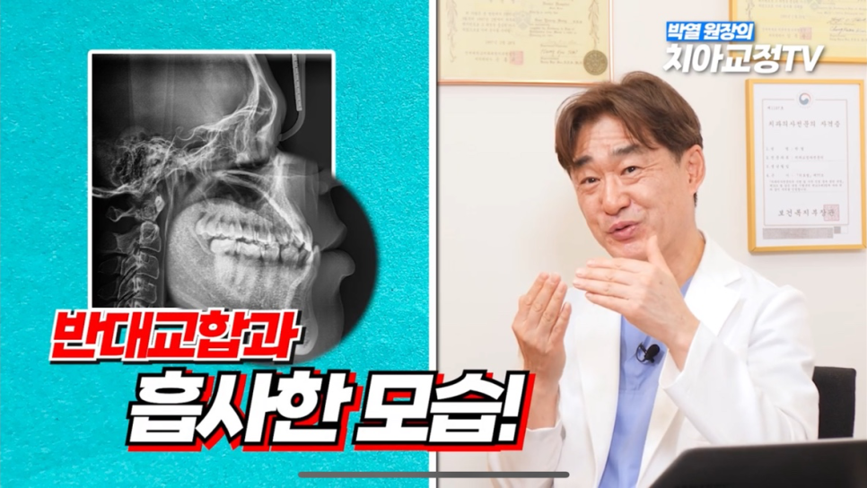 Can Adult Crossbite Be Treated With Orthodontic Dental Care? image 19