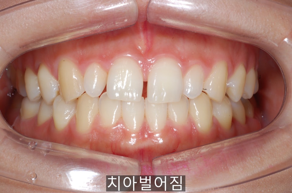 20세이상의 치아벌어짐, 교정 Vs 라미네이트! 관련 이미지 2
