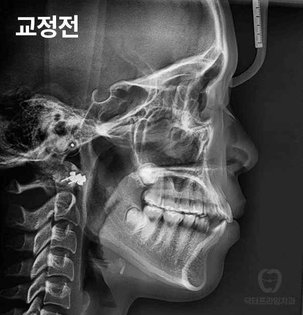 강남역 교정치과, 돌출입 발치교정하면 합죽해진다? 그렇습니다. 사실입니다 관련 이미지 24
