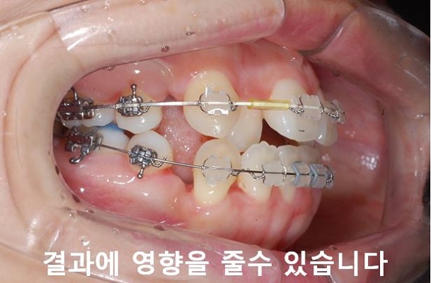 덧니교정 조심할것 3가지 관련 이미지 4