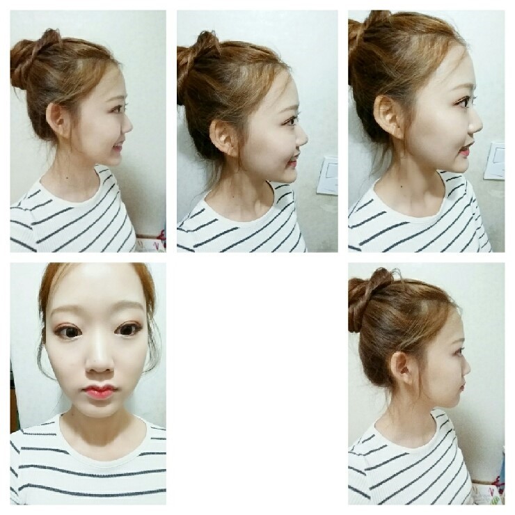 [치아교정후기] 앞니돌출교정후기(11) 관련 이미지 2