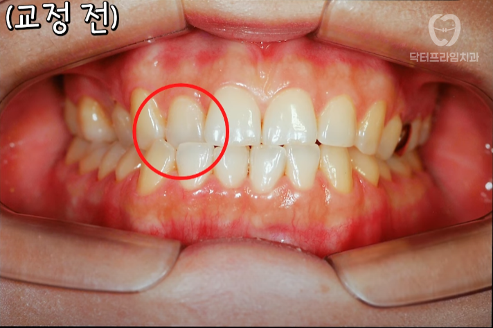 Facial asymmetry turns out to be caused by tooth alignment—can be improved with orthodontics! image 8