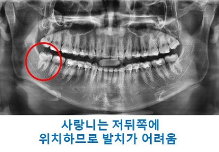 교정시작을 망설이게 하는 치아교정통증(1) 관련 이미지 9