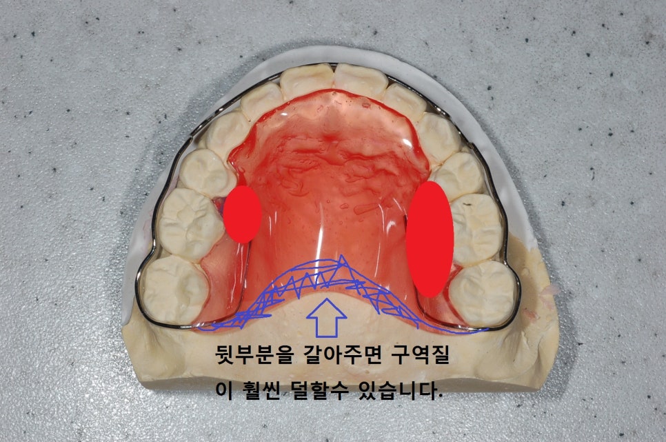 [치아교정] 유지장치 불편함 관련 이미지 1