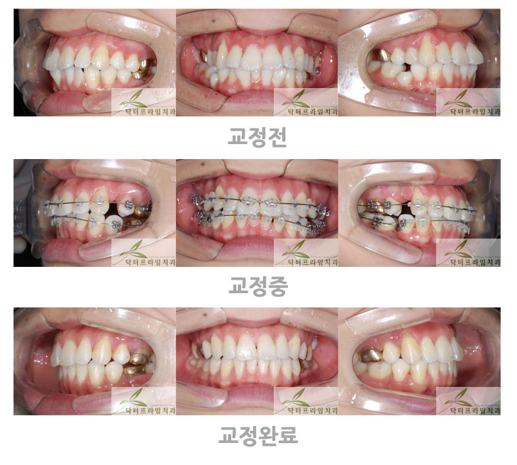 [치아교정후기] 치열이 고르지 않은 돌출입교정전후 관련 이미지 1