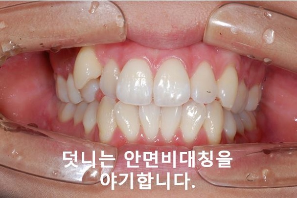 청소년, 덧니교정 안하면 이렇게 된다! 관련 이미지 7