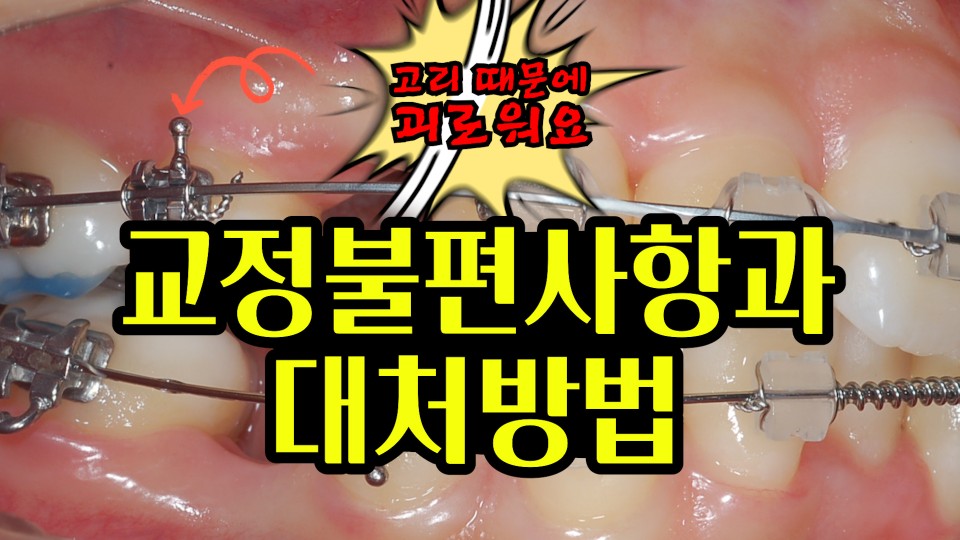 치아교정불편사항과 대처방법! (교정기에 달린 고리) 관련 이미지 1