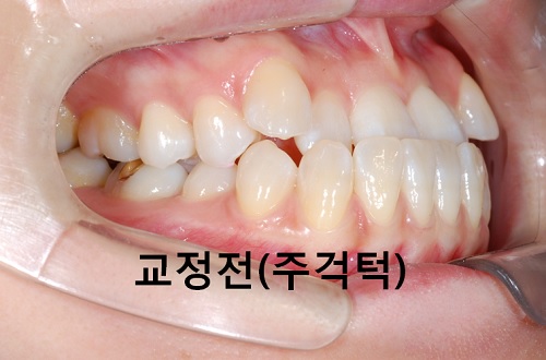 덧니와 주걱턱이 같이 있는 경우에 가장 효과적인 교정방법! 관련 이미지 13