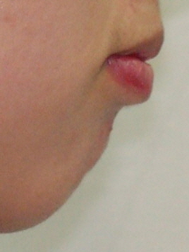 치아교정으로 무턱개선이 잘되는 경우와 그렇지 않은 경우 관련 이미지 1