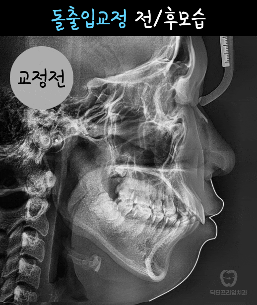 이미 교정했는데 입이 다시 나와 보여요&hellip; 재교정이 필요한 걸까요? 관련 이미지 2